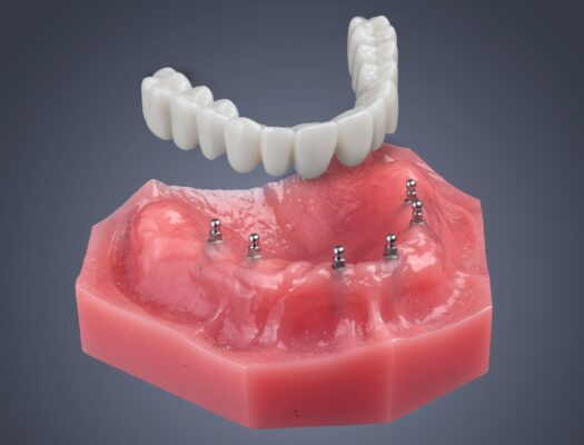 Implantes dentales híbridos en Las Vegas
