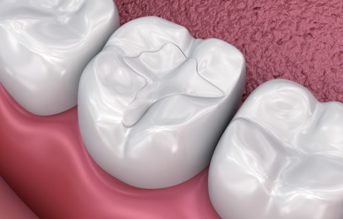 Beneficios de los empastes dentales en Las Vegas Rellenos dentales Vegas Dental Experts