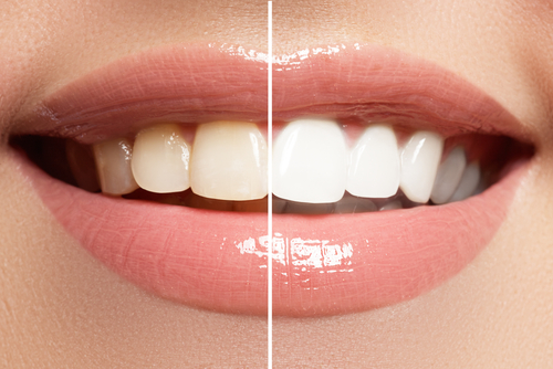 Cosmetic Dentistry in Las Vegas - Teeth Whitening