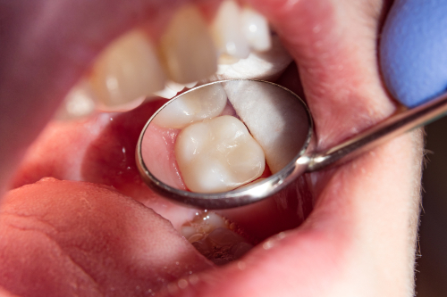 Dental Fillings in Las Vegas Tooth Fillings Vegas Dental Experts