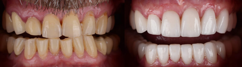 Full Mouth Reconstruction in Las Vegas