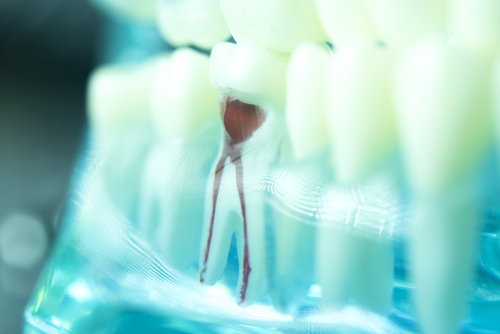 Root Canal Treatment in Las Vegas
