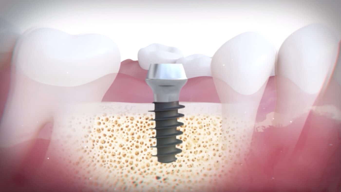 Transform Your Smile with the MagiCore Implant Dr. Harvey Chin