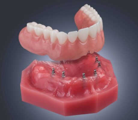 Implant Dentures in Las Vegas Free Consultation 