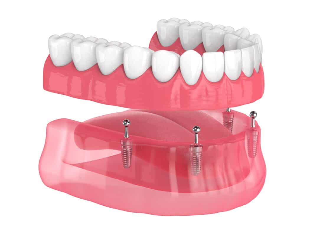 Implant Supported Dentures in Las Vegas Dr. Harvey Chin