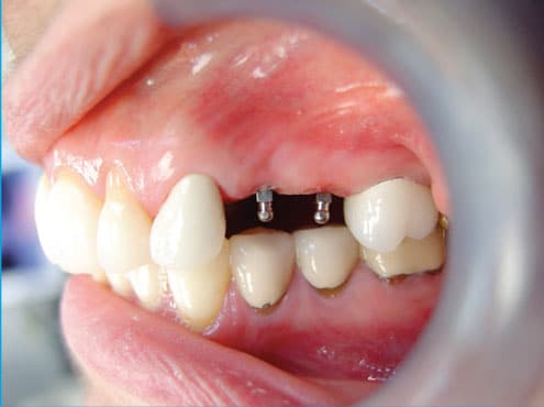 Mini Implants The Best Option to Replace Missing Teeth