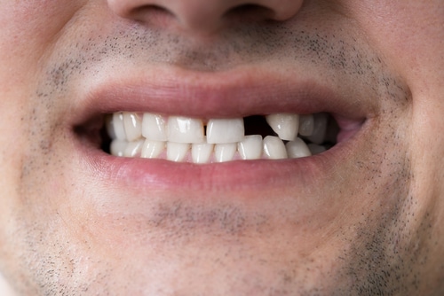 Falta de dientes ¡Podemos ayudar! Llame Vegas Dental Experts Hoy