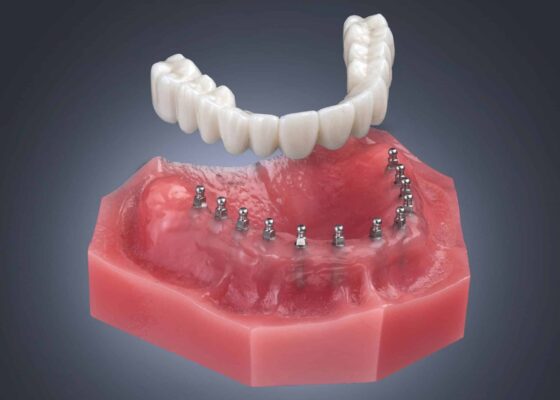 All-on-4 Dental Implants vs. Mini Dental Implants in Las Vegas, NV