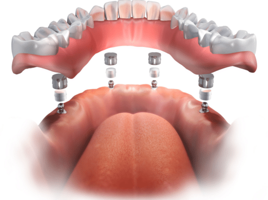 Denture Stabilization Benefits  Vegas Dental Experts 