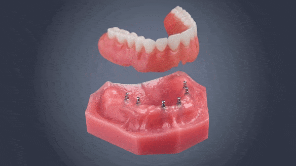 Implant Dentures in Las Vegas | Free Consultation