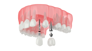 Costo de Mini Implantes en Las Vegas, NV | Odontología de Implantes | Dientes Nuevos