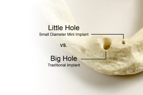 Implant Bridges in Las Vegas Mini Dental Implant Centers of America Dr. Harvey Chin