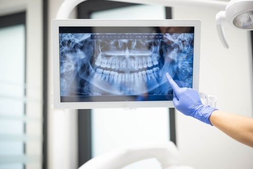 Minimally Invasive Dental Implants in Las Vegas, NV | Call Today!