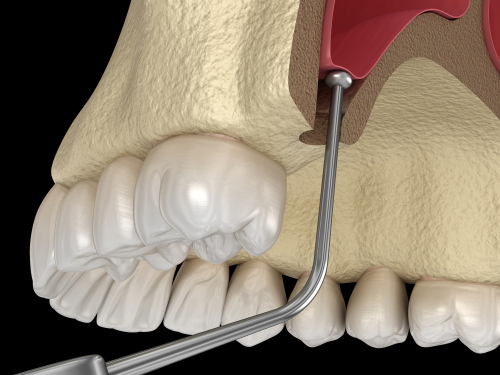 Sinus Lift Surgery in Las Vegas, NV | Minimally Invasive Dentistry