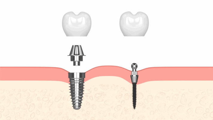 Screwless Dental Implants in Las Vegas, NV | Free Consultations!