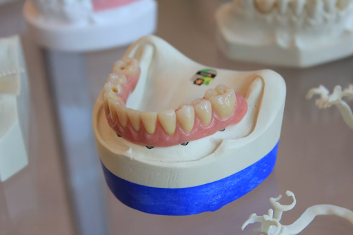 on all 4 dental implants